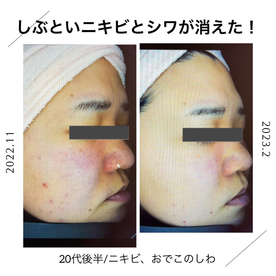 ニキビ・額の皺/30代/京都市